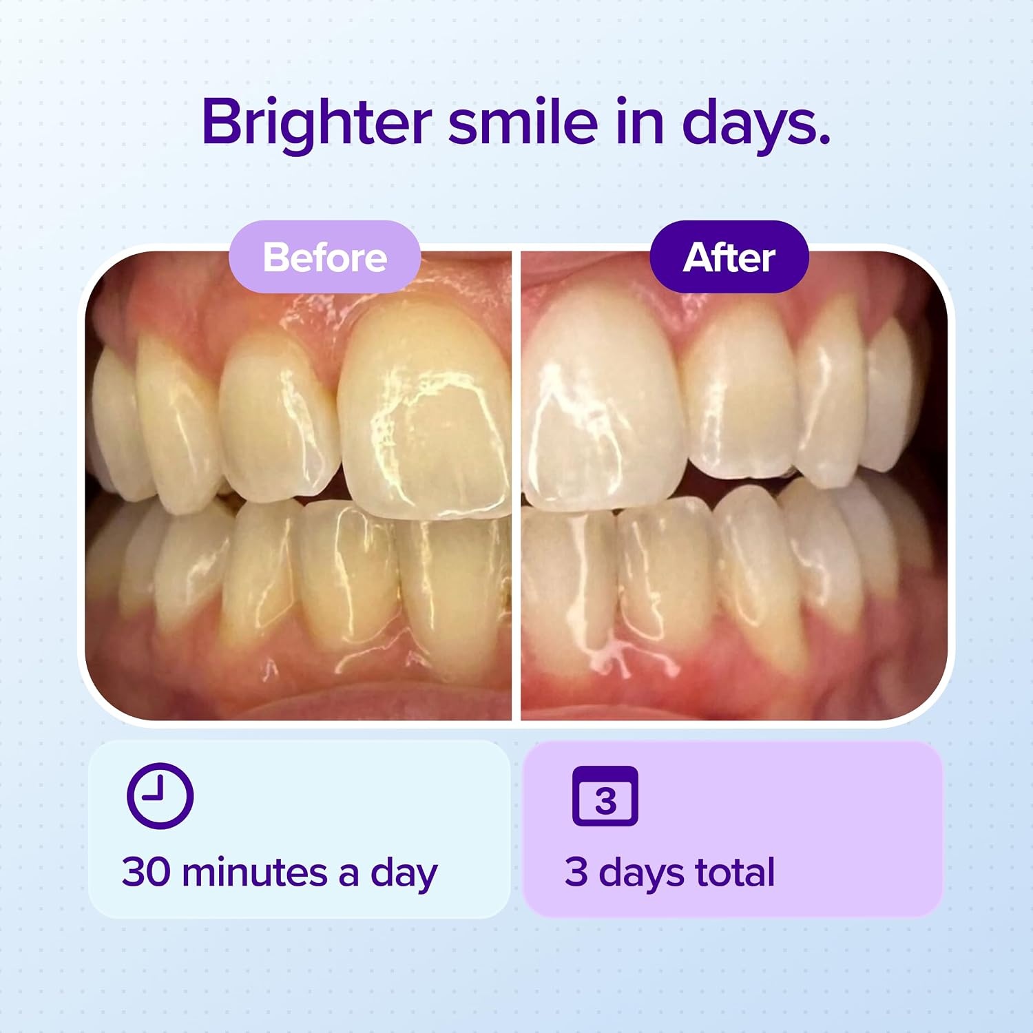 image:imageBURST Prefilled Teeth Whitening Trays 6 Trays3 Treatments Gel Trays
